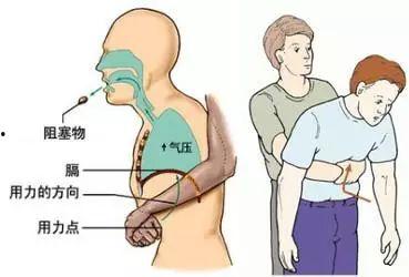 噎食急救视频,关键时刻救命！噎食急救视频详解